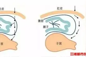 释疑：奚梦瑶的“无痛”剖宫产，到底是怎么做的图片