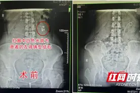 女子患肾结石却不以为意 5年后“小黄豆”竟长成“生姜”巨石图片
