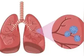 肺部结节出现这几种表现，基本就可以排除肺癌可能！图片
