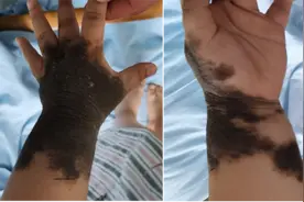 男孩的手腕小臂布满“兽皮痣”！ 医生将他的手“种”在肚皮里……图片