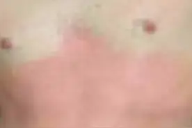 认识烧烫伤 遇到不慌张图片