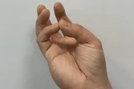 有腕管综合征的人越来越多！不重视或致残图片