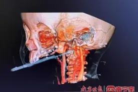 大意！广西1岁半女童咬筷子玩耍，不慎插入喉咙！医生紧急提醒图片