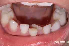 孩子长了难看的“双排牙”怎么办？专家：多给孩子啃食硬食物图片