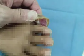随手修老茧，女子严重感染痛失脚趾图片