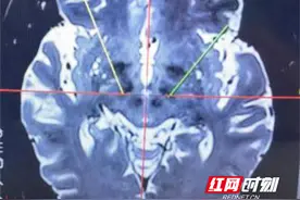 首例DBS手术成功开展，南华医院帕金森病诊疗开启新篇章图片