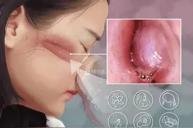 【朝医科普】过敏性鼻炎认识与防护图片