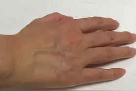 医生提醒：这3处青筋异常凸起要留意！图片