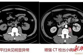 增强CT到底“强”在哪？图片