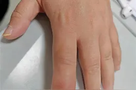 吃烧烤时不慎被竹签扎到，女子险些失去手指图片