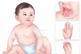 秋季常见传染病——手足口病图片