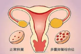什么是多囊卵巢综合征？多囊卵巢综合征有哪些症状？图片