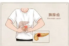 令人谈之色变的TA，如何应对丨世界胰腺癌日图片