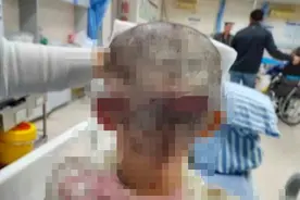 揪心！7岁女童遭恶犬撕咬重伤毁容，家属称狗主人至今未赔偿，家中积蓄已花光……图片