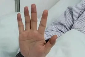 手部频繁出汗可能是一种病，如何才能告别“水手”？图片