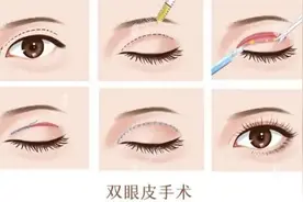 想割双眼皮，这些注意事项需了解丨健康智慧屋图片