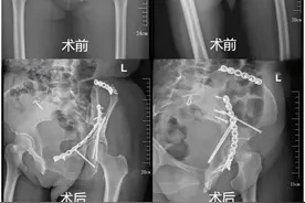 女子高处坠落致骨盆髋臼骨折，“天花板”级骨科手术助其精准复位图片
