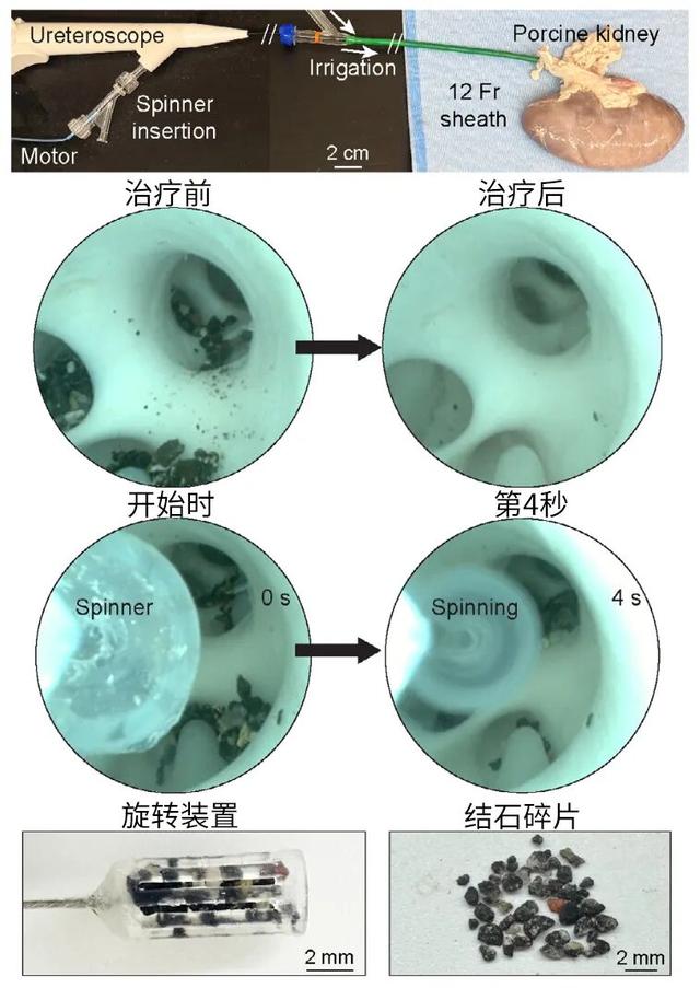 就像搓棉球，这种机器人能进血管把血栓“搓”小95%