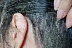 眼皮跳、脸部抽动或是“面肌痉挛” 广州阿姨做手术终于治好图片