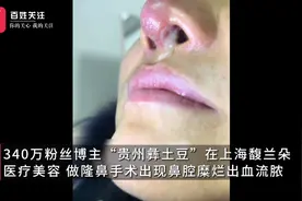 花8万整驼峰鼻，被整成骆驼鼻，340万粉丝网红哭诉：整容医院不管我图片