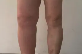 拖着“大象腿”，福州女子辗转多家医院，被诊断为疑难杂症！最后竟在妇科治好图片