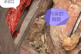一阵剧烈呕吐，她竟将食管吐裂了 春节期间出现这种情况，千万不要强忍！图片