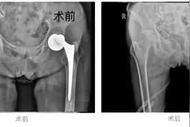 贵阳市第四人民医院成功治愈94岁高龄髋关节置换术后假体脱位患者图片