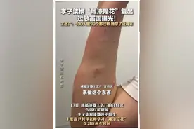 热搜！李子柒为拍视频皮肤过敏结痂，听听专家怎么说图片