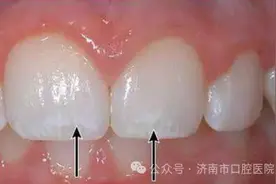孩子牙齿上的白斑是怎么回事？图片