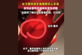 女生晒照被网友提醒有“瘤”？真的救命了！医生回应……图片