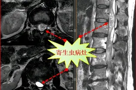 15年前“生吞蛇胆”，广东阿叔脊髓内长出一团寄生虫图片