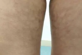 长沙22岁女子腿上长满红斑！冬季爱上烤火桌的南方人要注意这种皮肤病图片