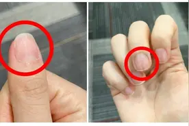指甲出现这些纹路，是身体在发出“警报”？多图详解→图片