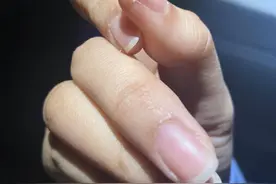 一到冬天手指头就开裂，到底应该怎么办？|扬子懂健康图片