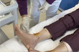 糖尿病患者泡脚致足部破溃感染，水温要控制在……图片
