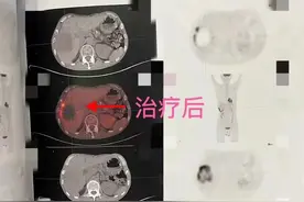 一年间确诊癌症晚期，两个月峰回路转→图片