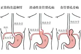 反酸烧心就是得了胃病？不一定！这种病很容易误诊漏诊图片