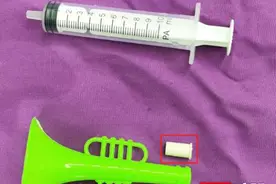 玩具零件误入儿童气管！专家巧手精准取出图片