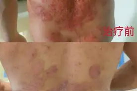 “终于可以睡个好觉了！”河北男子银屑病缠身20余年，辗转近千里来汉治疗图片