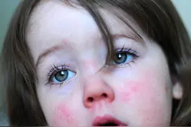 暂无疫苗可预防！疾控提醒：警惕猩红热图片