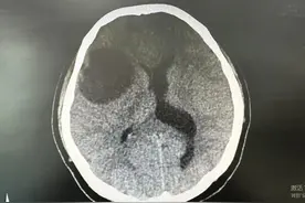 女子被头疼折磨三个月，一查竟是脑肿瘤！别觉得年轻就放松警惕图片