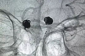 不开颅，一次拆“双弹”！双动脉瘤患者获救图片