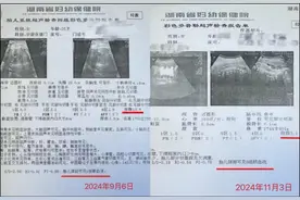 “调皮的生命线” 脐带绕颈5周宝宝在湖南省妇幼保健院平安出生图片