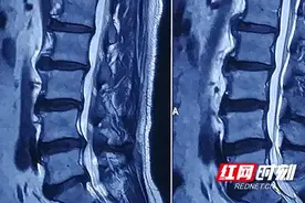 大爷被频频“电击”是怎么回事？ 原来是腰椎间盘突出惹的祸图片