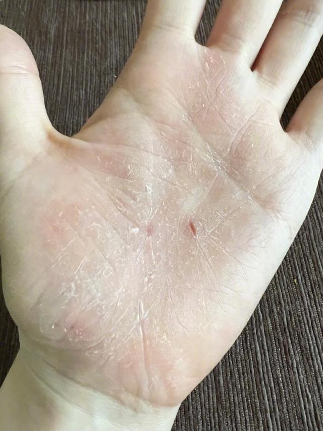 张靓颖自曝体检营养不良