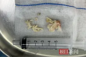 糖友在私人诊所拔罐放血治腰腿痛，反致皮肤大面积破溃“遭老罪”图片