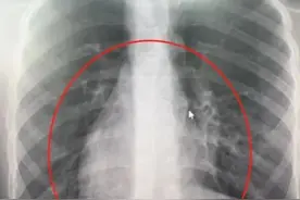 心脏在右，肝胆在左，医生“反手”为“镜像人”切除阑尾图片