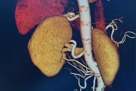 北京大学第三医院泌尿外科完成首例机器人辅助腹腔镜下活体供肾切取术图片