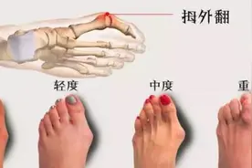 大医生开讲｜大脚趾长歪了，小心是“踇外翻”！女性更要警惕图片