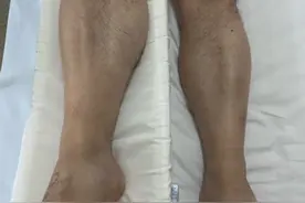 右腿疼痛浮肿，男子确诊静脉血栓！医生提醒：揉腿、拍打很危险图片